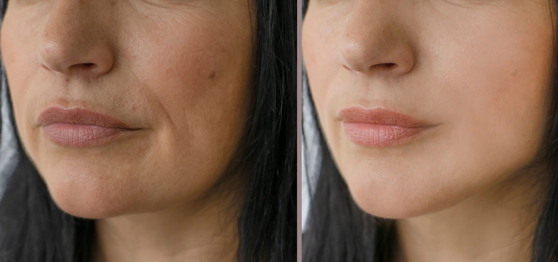 Scarlet RF microneedling skin transformation treatment