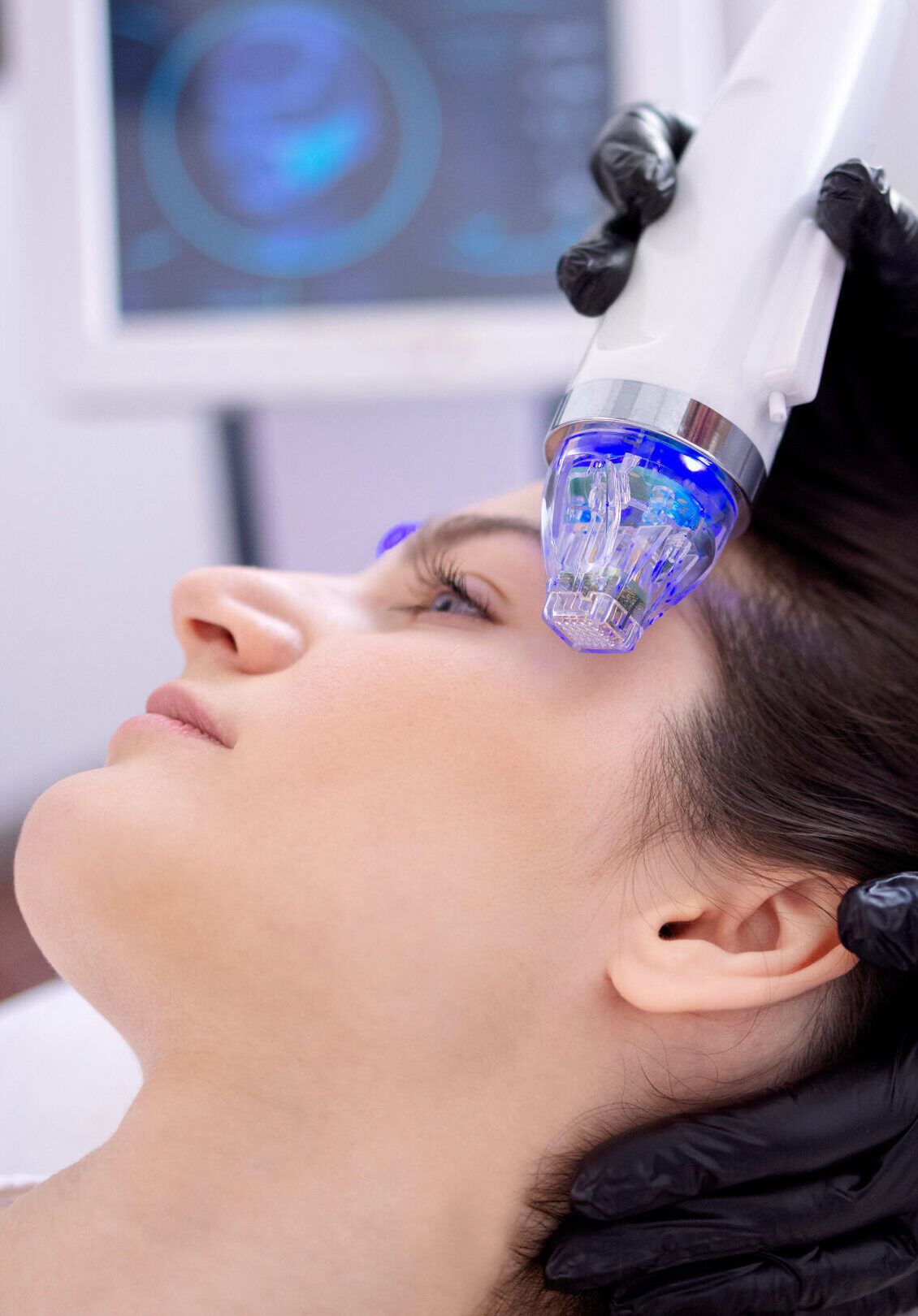 RF microneedling and laser treatment at Miracle Wellness