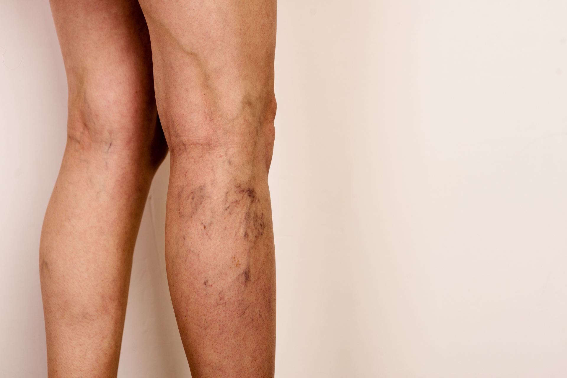 Vein Treatments